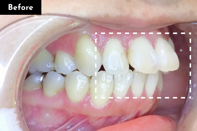 出っ歯治療前 - Oh my teeth マウスピース矯正Basicプラン症例 Case 05