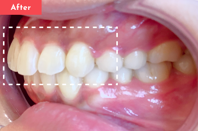 出っ歯治療後 - Oh my teeth マウスピース矯正Proプラン5ヶ月の症例 Case 06