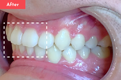 出っ歯治療後 - Oh my teeth マウスピース矯正Basicプラン7ヶ月の症例 Case 07