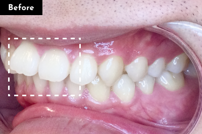 出っ歯治療前 - Oh my teeth マウスピース矯正Basicプラン症例 Case 07