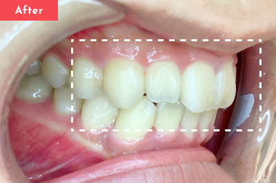 出っ歯治療後 - Oh my teeth マウスピース矯正Basicプラン8ヶ月の症例 Case 08