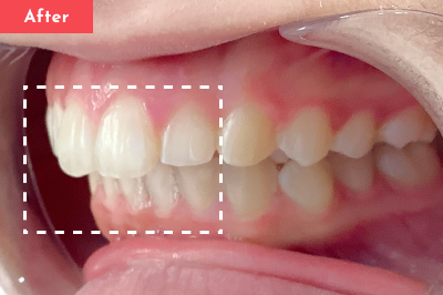 出っ歯治療後 - Oh my teeth マウスピース矯正Basicプラン4ヶ月の症例 Case 10