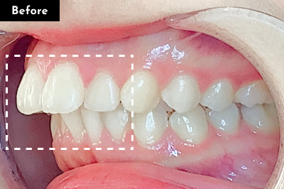 出っ歯治療前 - Oh my teeth マウスピース矯正Basicプラン症例 Case 10