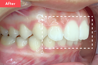 出っ歯治療後 - Oh my teeth マウスピース矯正Basicプラン4ヶ月の症例 Case 11