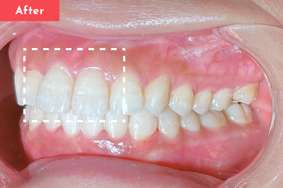 出っ歯治療後 - Oh my teeth マウスピース矯正Proプラン13ヶ月の症例 Case 12