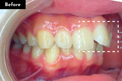 出っ歯治療前 - Oh my teeth マウスピース矯正Basicプラン症例 Case 13