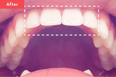 叢生治療後 - Oh my teeth マウスピース矯正Liteプラン2ヶ月の症例 Case 14