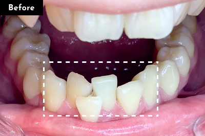 叢生治療前 - Oh my teeth マウスピース矯正Basicプラン症例 Case 15