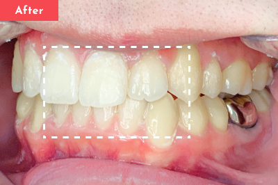 叢生治療後 - Oh my teeth マウスピース矯正Proプラン8ヶ月の症例 Case 16