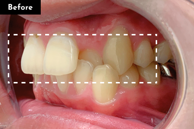 叢生治療前 - Oh my teeth マウスピース矯正Proプラン症例 Case 16