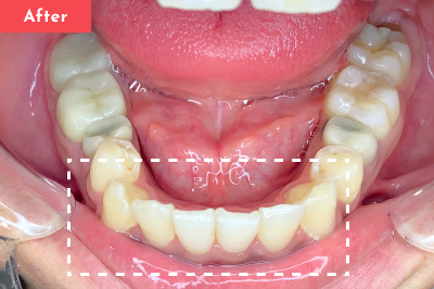 叢生治療後 - Oh my teeth マウスピース矯正Basicプラン5ヶ月の症例 Case 17