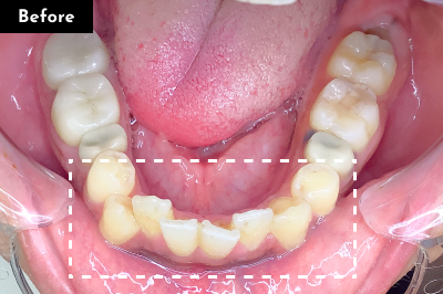 叢生治療前 - Oh my teeth マウスピース矯正Basicプラン症例 Case 17
