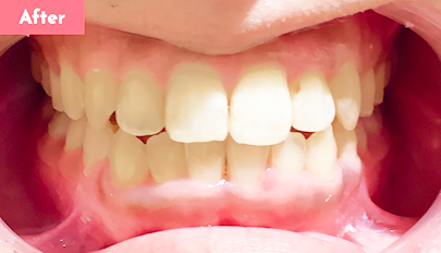 叢生治療後 - Oh my teeth マウスピース矯正インビザラインプラン9ヶ月の症例 Case 18