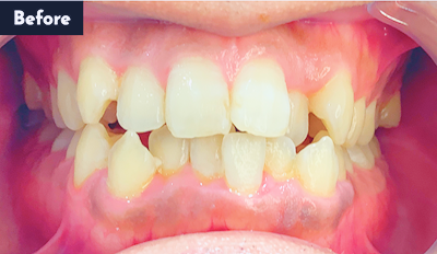 叢生治療前 - Oh my teeth マウスピース矯正インビザラインプラン症例 Case 18