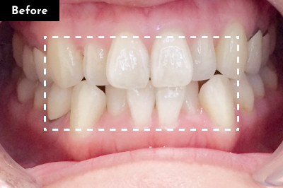叢生治療前 - Oh my teeth マウスピース矯正Basicプラン症例 Case 19