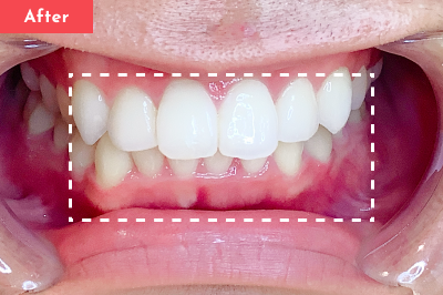 叢生治療後 - Oh my teeth マウスピース矯正Basicプラン4ヶ月の症例 Case 20