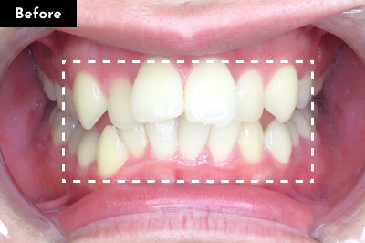 叢生治療前 - Oh my teeth マウスピース矯正Basicプラン症例 Case 20