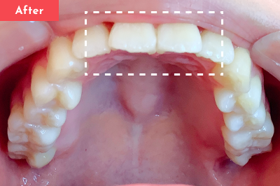 叢生治療後 - Oh my teeth マウスピース矯正Basicプラン7ヶ月の症例 Case 21