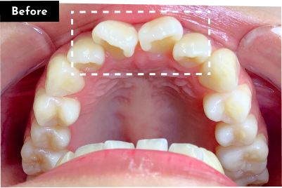 叢生治療前 - Oh my teeth マウスピース矯正Basicプラン症例 Case 21