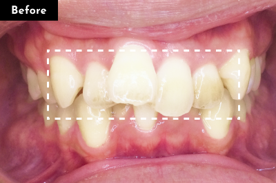 叢生治療前 - Oh my teeth マウスピース矯正Proプラン症例 Case 22
