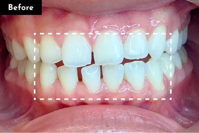 すきっ歯治療前 - Oh my teeth マウスピース矯正Basicプラン症例 Case 26