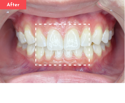 すきっ歯治療前 - Oh my teeth マウスピース矯正Basicプラン症例 Case 27