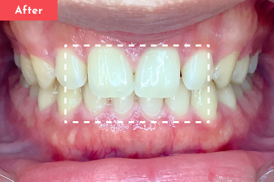 すきっ歯治療後 - Oh my teeth マウスピース矯正Proプラン7ヶ月の症例 Case 28