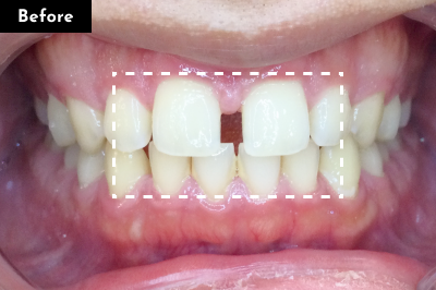 すきっ歯治療前 - Oh my teeth マウスピース矯正Proプラン症例 Case 28