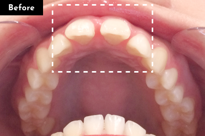 すきっ歯治療前 - Oh my teeth マウスピース矯正Basicプラン症例 Case 29