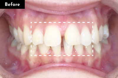すきっ歯治療前 - Oh my teeth マウスピース矯正Basicプラン症例 Case 33